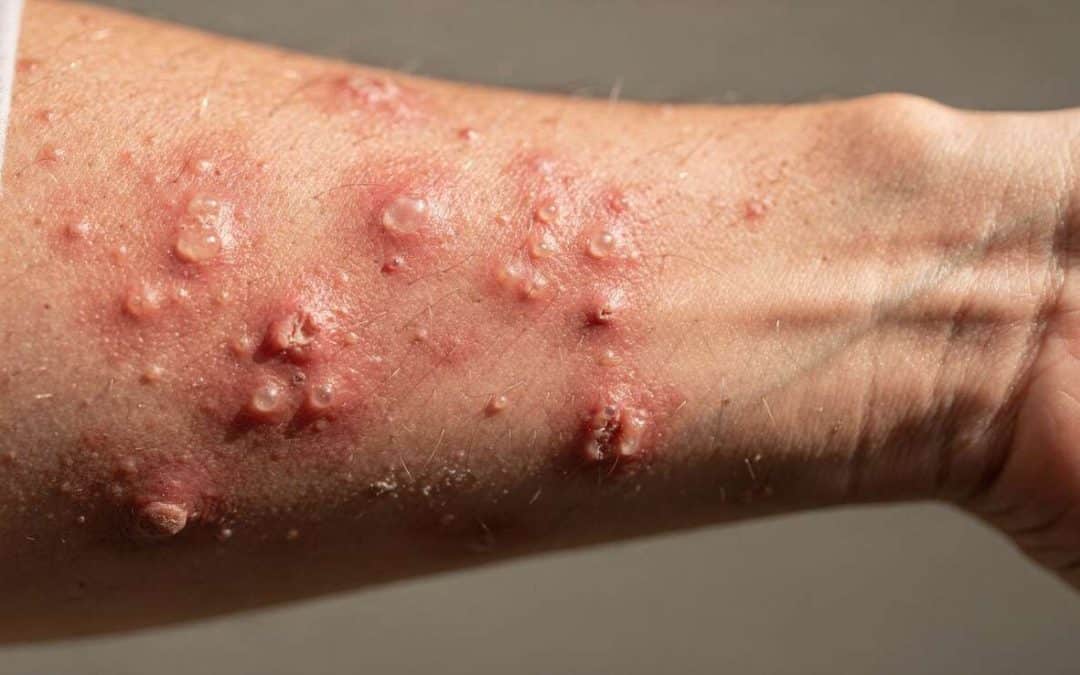 Dermatite herpétiforme : comprendre la maladie coeliaque