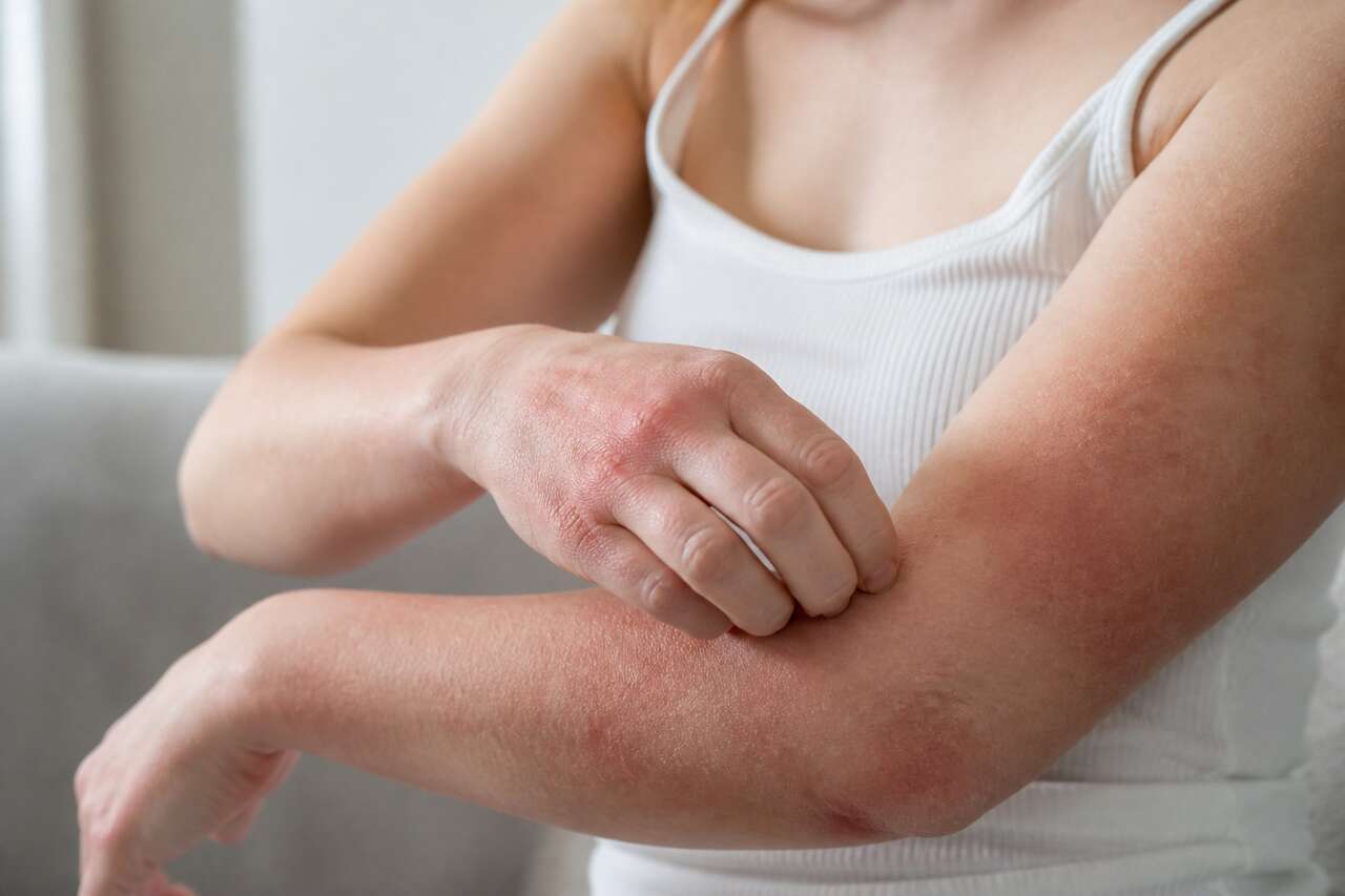 Peau sèche, carences et autres signaux : ce que la cœliaquie peut aussi provoquer Peau sèche, carences et autres signaux : ce que la cœliaquie peut aussi provoquer